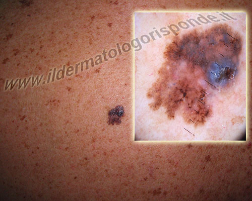fotografare la pelle in modalità macro con la dermatoscopia
