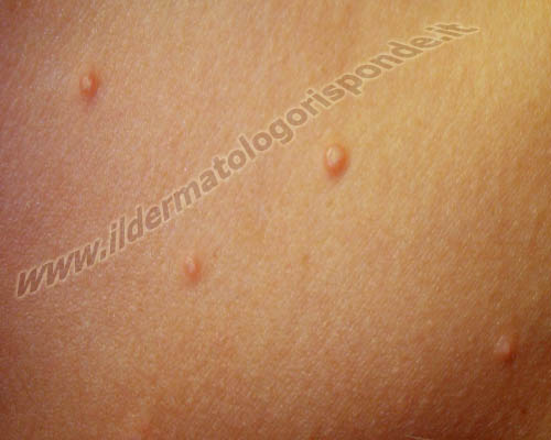 mollusco contagioso cura