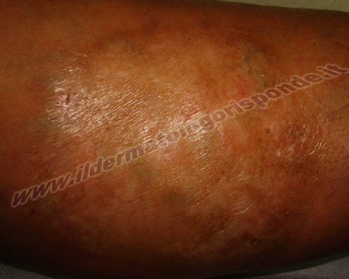 morfea foto di sclerodermia localizzata agli arti