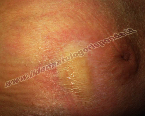 sclerodermia localizzata foto di chiazza sclerodermica della mammella