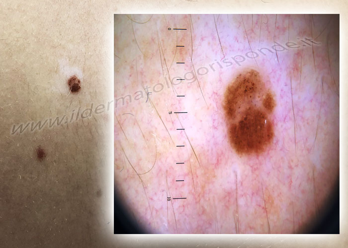 nevo di Sutton dermatoscopia