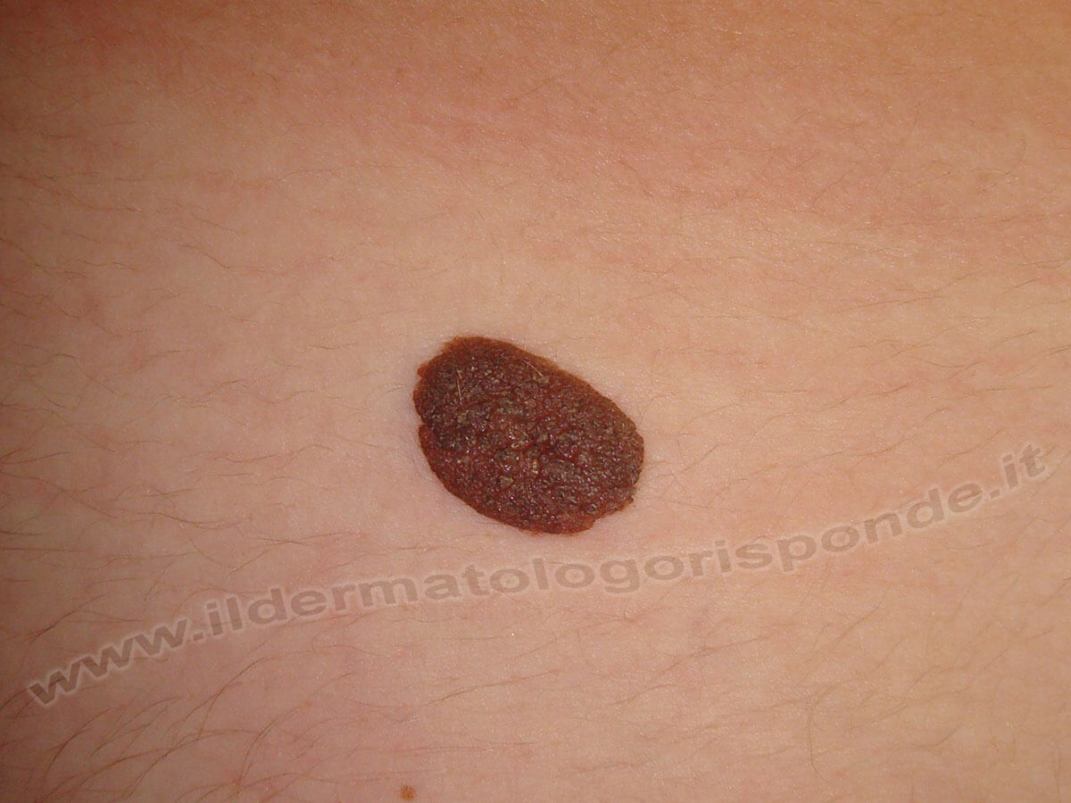 Nevo Di Miescher E Nevo Di Unna Sul Viso E Sul Corpo Nevo Di Miescher E Nevo Di Unna Sul Viso E Sul Corpo