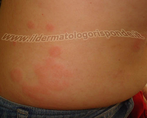 orticaria