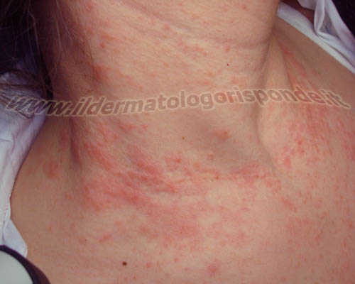 nell’orticaria colinergica o da sforzo, i pomfi possono comparire in seguito a sforzo fisico