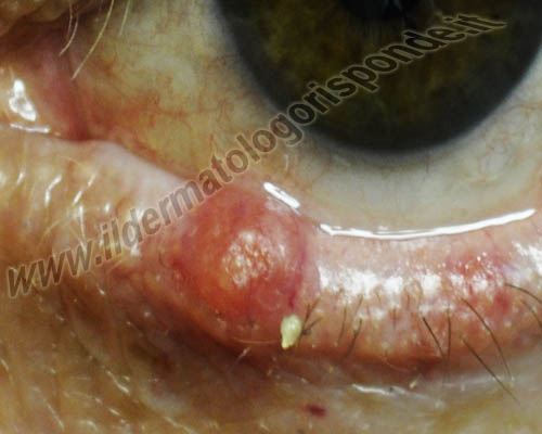 immagine di orzaiolo localizzato alla palpebra inferiore