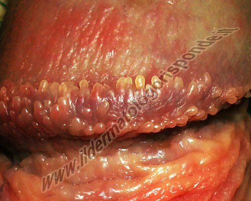 immagini di papule perlacee (papille del glande) disposte alla base del pene
