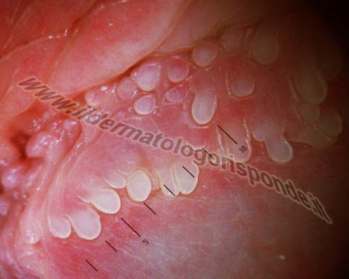 immagini di penoscopia delle papule perlacee della corona del glande