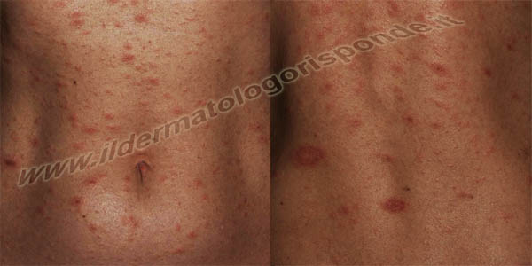 Pitiriasi Rosea Di Gibert Con Immagini Cliniche