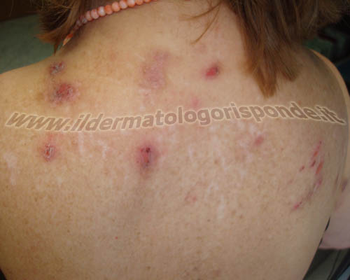 sindrome di Morgellons la prurigo nodulare può talora presentarsi con sintomi simili a quelli descritti nella sindrome Morgellons