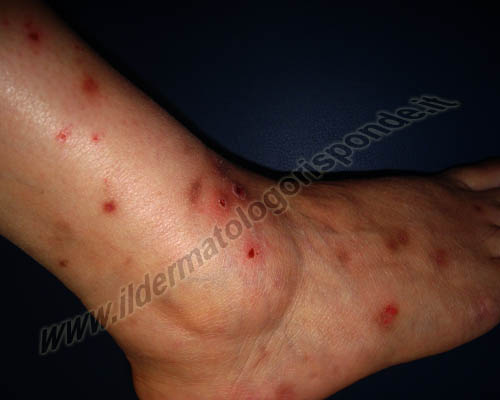 immagini di prurigo nodulare in individuo affetto da orticaria papulosa