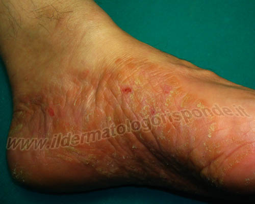 immagini di dermatite ai piedi con intenso prurito plantare