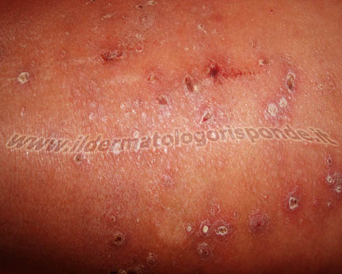 Morbo di Morgellons prima di parlare di morbo di Morgellons, bisogna escludere le malattie della pelle a eziologia nota