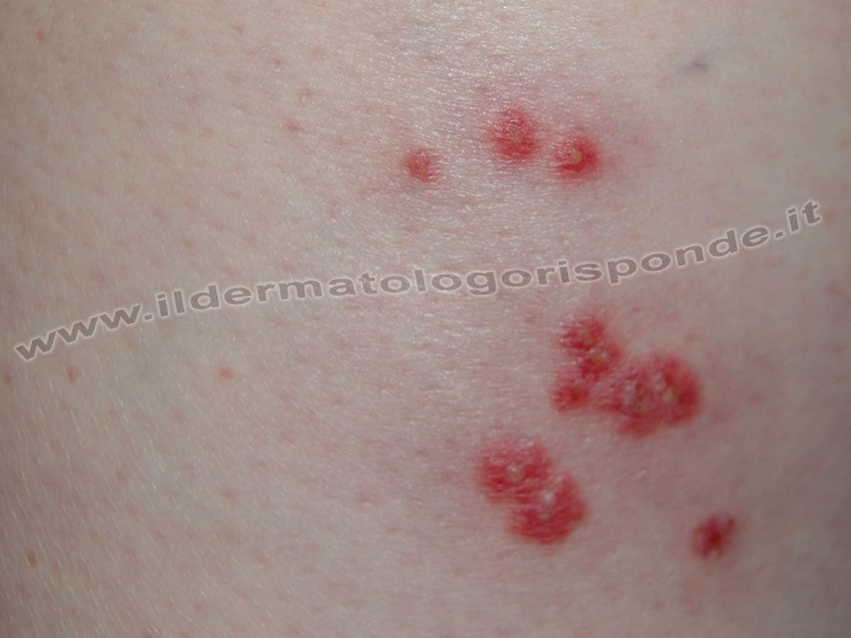 pseudoangiomatosi eruttiva Immagini di pseudoangiomatosi eruttiva in età pediatrica