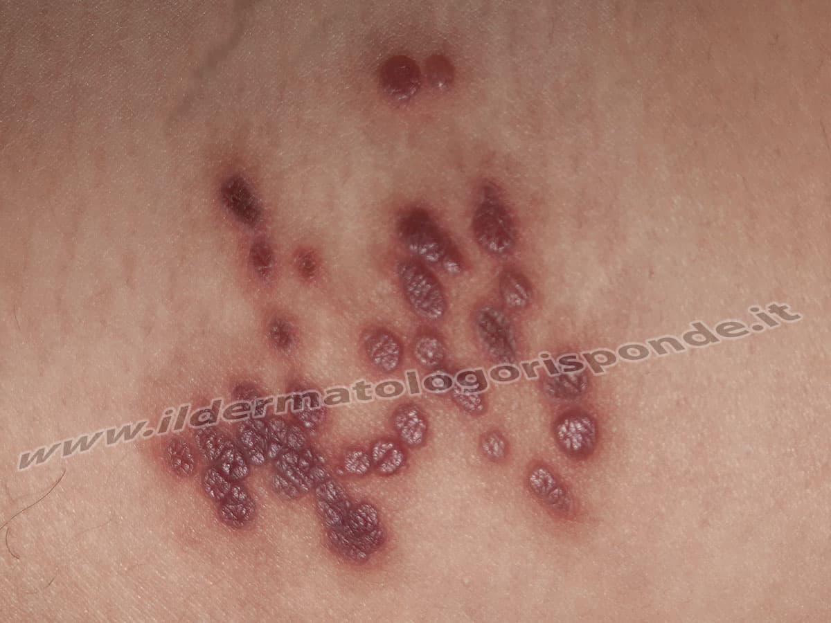 Diagnosi differenziale tra pseudoangiomatosi eruttiva e herpes zoster