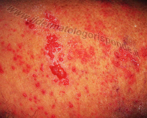 pseudoangiomatosi eruttiva Immagini di pseudoangiomatosi eruttiva in paziente con herpes zoster