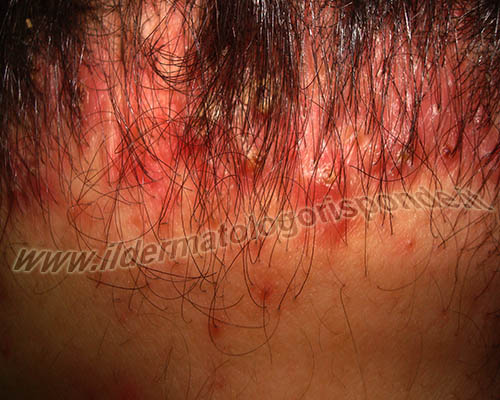 psiconeuroimmunodermatologia la psiconeuroimmunodermatologia e le interazioni mente, cervello e pelle