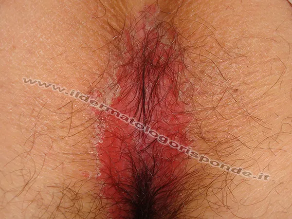psoriasi perianale psoriasi perianale in paziente anziano