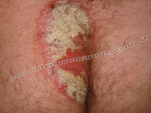 psoriasi paziente con psoriasi volgare dei glutei e della zona anale