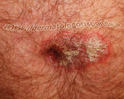 Dermatite di atopic e curva di una cistifellea