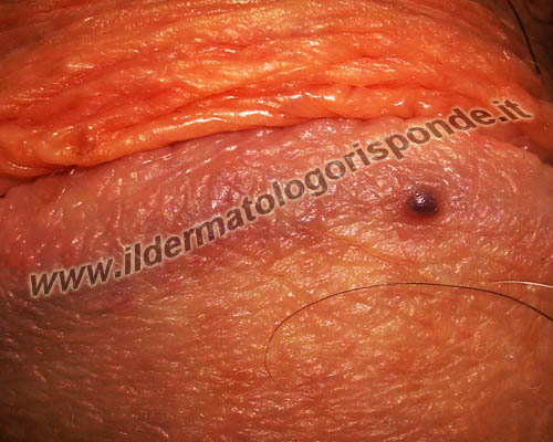 angiocheratomi differenza tra angiocheratomi e malattie a trasmissione sessuale