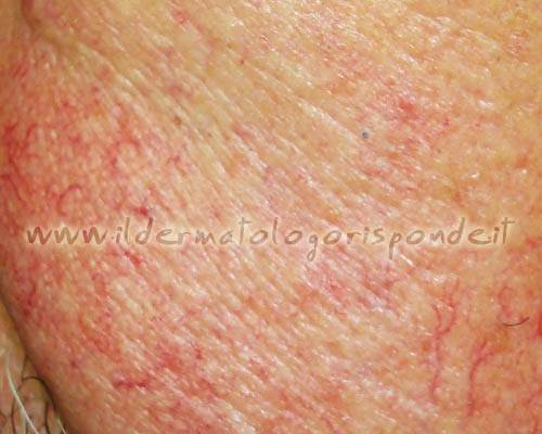 rosacea viso