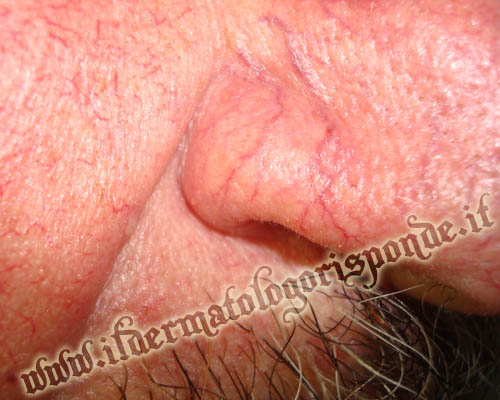 rosacea naso