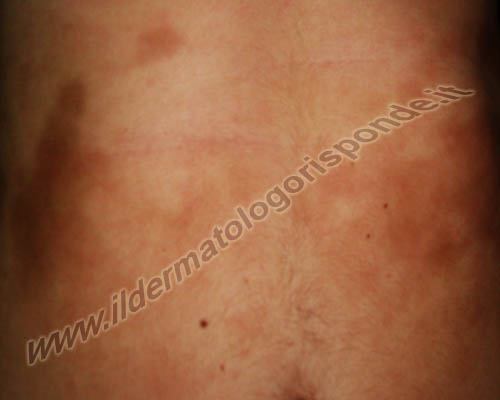 l’immagine mostra una morfea localizzata alla pelle