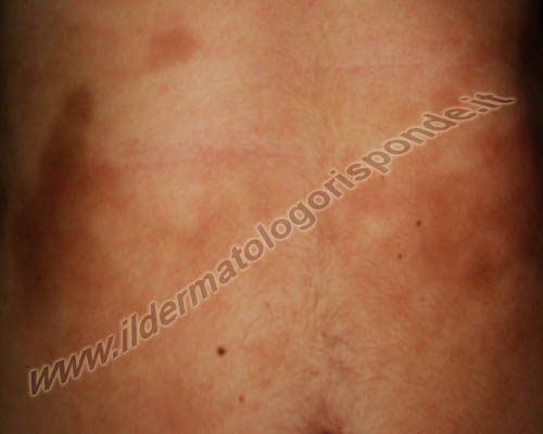 sclerodermia l’immagine mostra una morfea localizzata alla pelle