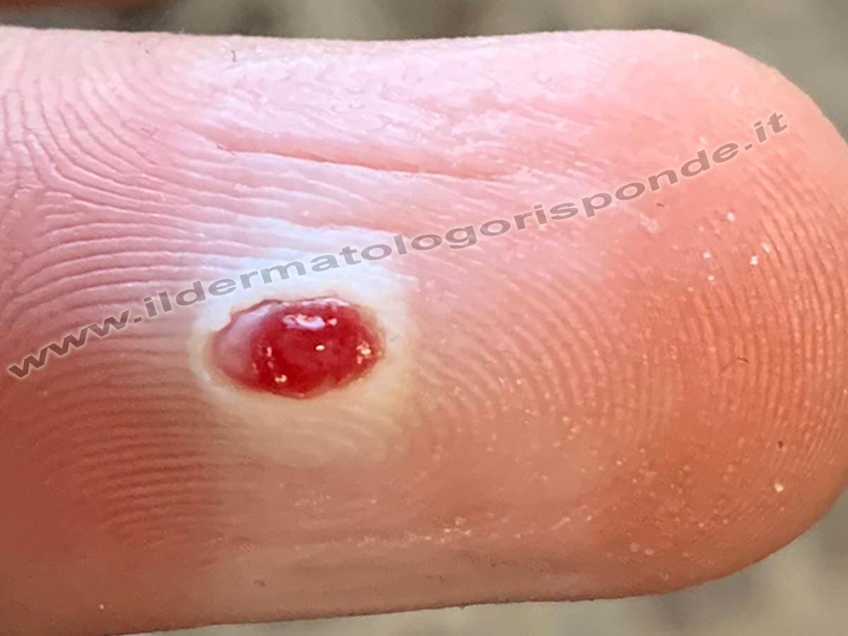 Granuloma piogenico della pelle: quando asportarlo