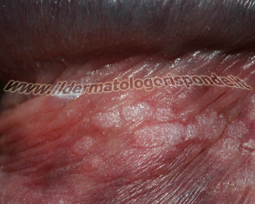 dermatologia balanoprepuziale immagine di condilomi del solco balano prepuziale