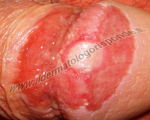 foto di ulcera genitale, caratterizzata da una marcata erosione a livello del glande