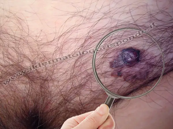 vestibolite vulvare in paziente con vulvodinia e melanoma vulvare