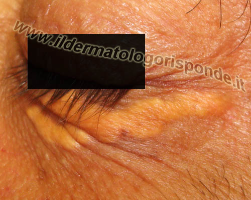 xanteasma xantelasma palpebrale trattato mediante crioterapia con azoto liquido