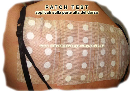 prove allergiche cutanee mediante patch test