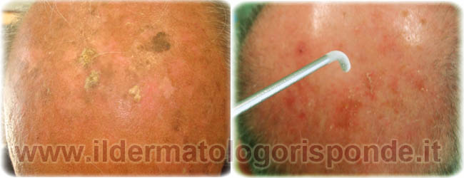 immagini di cheratosi attiniche osservate in dermatologia geriatrica