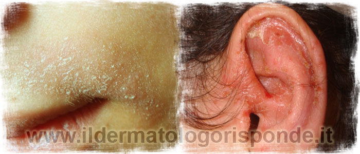 seborrea foto di dermatite seborroica del viso