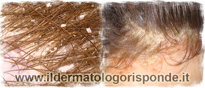 prurito al cuoio capelluto e perdita di capelli si possono verificare in presenza di sebopsoriasi o dermatite seborroica
