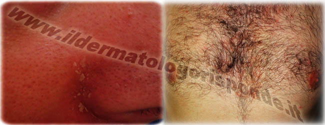 dermatite seborroica dermatite seborroica cura